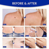 Skin Tag Remover Kit for Fast & Effective Skin Tag Removal